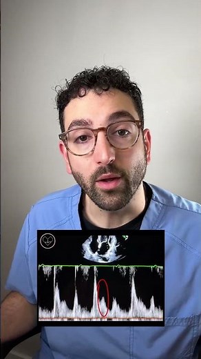 L Wave on Echocardiography