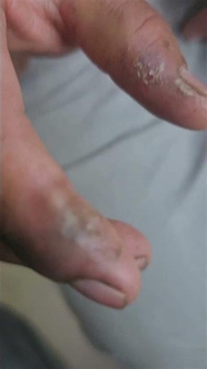 Tinea Infection