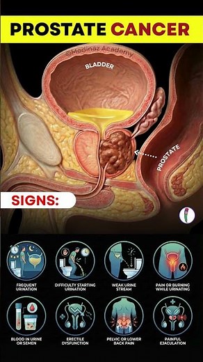 Early Prostate Cancer Symptoms That Can Save Your Life | Prostate Cancer