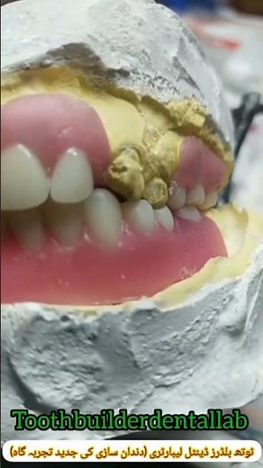 Partial dentures 🦷