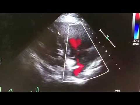 Eustachian Valve on Echocardiogram