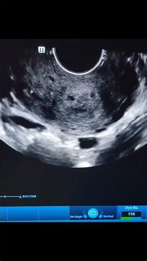 How to tell if your IUD is placed properly #ultrasound #iud #contraceptives #birthcontrol #shorts