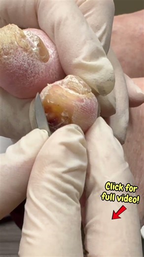 Removing Hard Corns on the Toe #shortsfeed #satisfyingshorts #shortsvideos