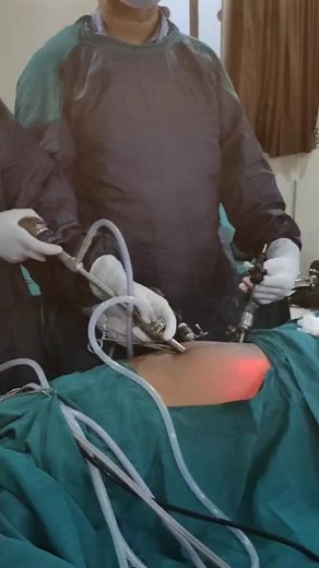 Laparoscopy Appendectomy Procedure At Udit Multispeciality Hospital Vansda #Appendix perforation