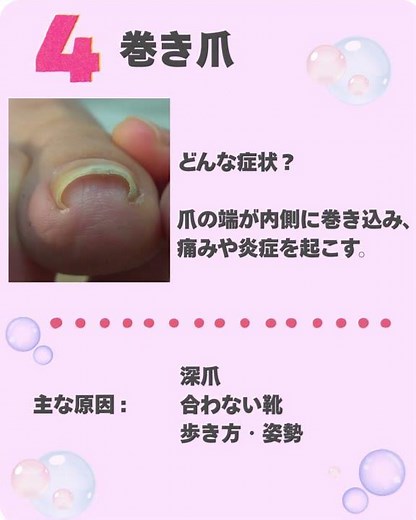 爪のトラブル5選症状＆原因編 1
