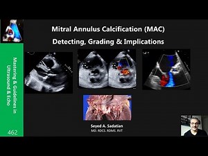 Mitral Annulus Calcification (MAC): Detecting, Grading & Implications