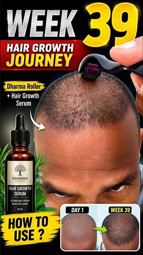 Derma Roller For Hair Growth Week 39 Shocking Results #hair #youtubeshorts