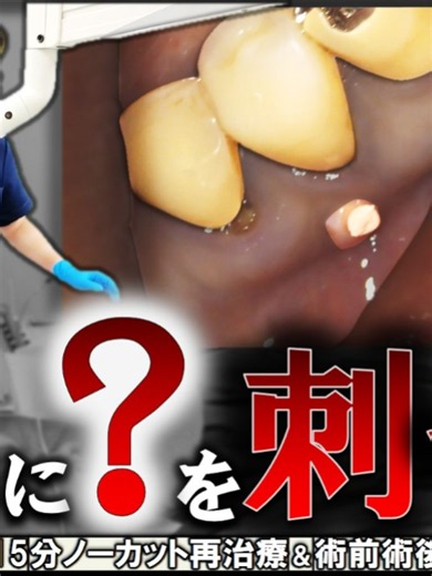 【膿の出口に〇〇を刺す】歯茎にできた膿の原因は何か？ノーカット15分再根管治療#宮崎歯科医院 #根管治療