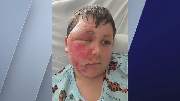 TikTok trend leaves 9-year-old boy with severe burns from microwaved ‘NeeDoh’ toy