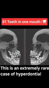 Hyperdontia is a dental developmental anomaly in which supernumerary teeth exist. These are extra teeth to the normal set of primary or permanent dentitions. #hyperdontia #teeth #dental #mbbs #dentist #mbbsstudent #viral #medical #tranding #doctor #nursing #nursingstudent #doctors #medicos #neetpg #fmge | medicalmania007
