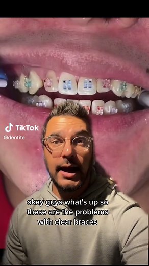 Tips for Clear Braces and Stain Removal