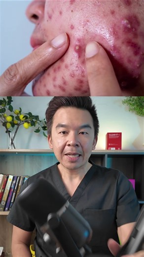 Cystic acne is deep, painful, and doesn’t go away easily . What helps: • Benzoyl peroxide cleanser – reduces bacteria • Adapalene (retinoid) – controls oil and inflammation • Oral treatment – for severe or persistent acne How to use: Use benzoyl peroxide cleanser (leave 1–2 min, then rinse) . Apply adapalene at night (start 2–3x/week) . For severe cases, see a doctor for oral treatment . Treat early to prevent scarring. What acne concern do you struggle with most?