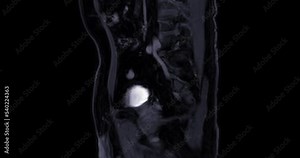 MRI prostate gland for diagnosis prostate cancer cell and evaluate the extent of prostate cancer in aged men.