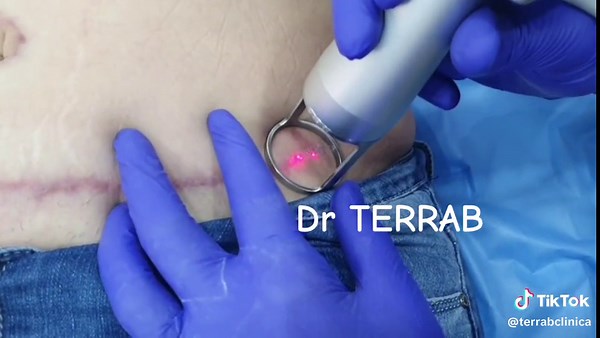 Traitement d’une cicatrice chirurgicale au laser CO2 #terrablaser #hydratation #epilationdefinitive #comblementdeslevres💋 #annaba #soinvisage #aestheticmedicine #blepharoplastie #co2 #beautiful #beauty #hydrafacial #cynosurelasers #fakeinjectors