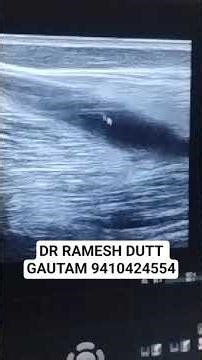 COLD ABSCESS ON LIWER BACK #usg #female #back #pus #fever #pain TB #abscess #msk