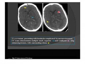 Radiological evaluation of extra pulmonary TB