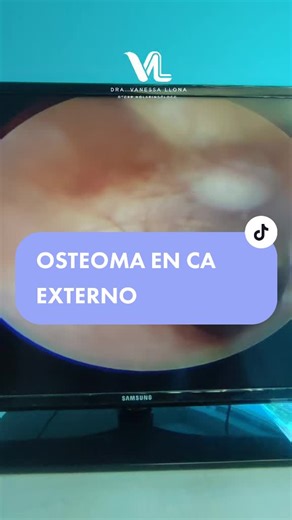 Los #osteomas de conducto auditivo externo son tumores benignos de tejido óseo, de lento crecimiento, en su mayoría unilaterales e inicialmente asintomáticos. El tratamiento depende del tamaño de la lesión y puede ser conservador o quirúrgico. Comenta con un 😯 si lograste verlo #orl #consulta #otorrino #otorrinoValencia #Venezuela