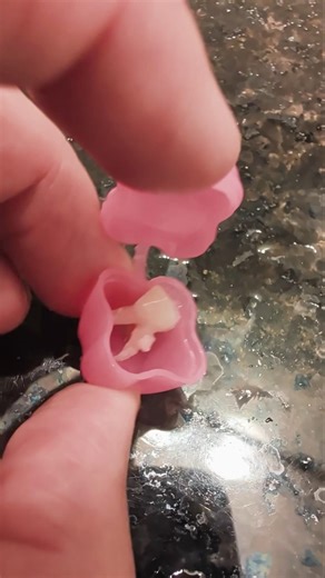 Child Baby Upper First Molar Extraction due to Decay