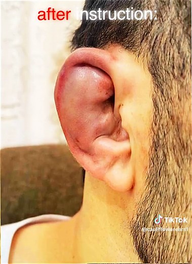 Proper Instructions for Treating Cauliflower Ears