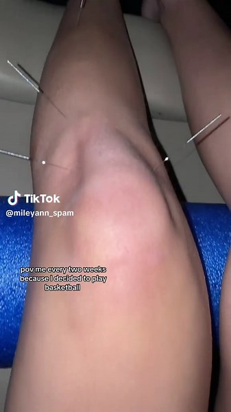 Managing Shin Splints with Acupuncture Techniques