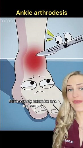 Doctor explains: ankle fusion surgery