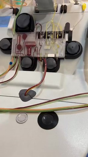 Plasmapheresis (also known as therapeutic plasma exchange) involves drawing blood from a patient,separating the plasma from the blood cells, and then returning the blood cells, along with a plasma substitute or donor plasma, back into the patient's bloodstream.The process is typically carried out using a machine called a plasmapheresis machine or apheresis machine. #Plasmapheresis #bloodbanking #laboratoryprofessionals