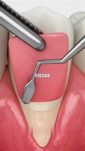 How Dentists Fix Receding Gums #facts #viral #shorts