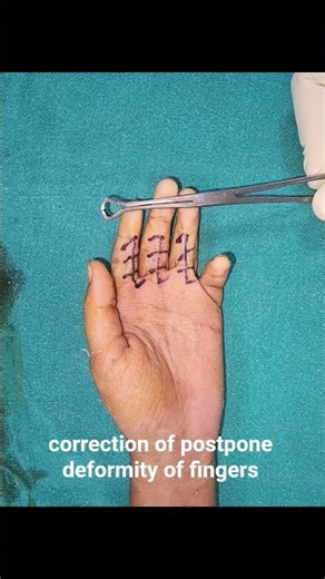 Post Burn deformity correction using Multiple z plasty, planning and marking explained by Dr Vikas