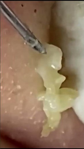 Oozy and satisfying – deep pus pimple extraction - Pimple Spa
