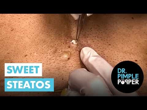 Three Cheers for Sweet Steatocystomas