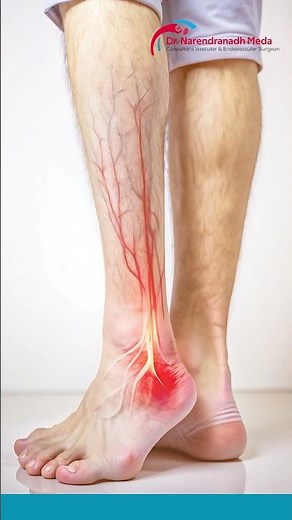 Long Flights Can Cause Blood Clots 😱 | DVT Warning Signs & Prevention | Dr Narendranadh Meda