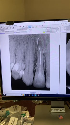 #diagnosis #properdiagnosis #endodontist #endotricks #rootcanaltherapy #rootcanaltreatment #rootcanal #microscopebasedendo #beethical #toothache #fyp