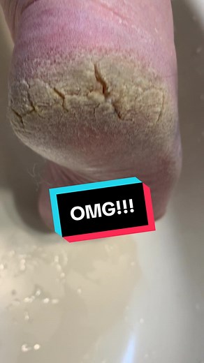 Effective Callus Remover - Foot Grinder for Quick Results