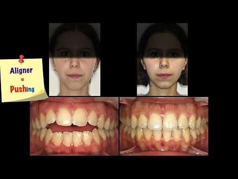 Skeletal open bite treated with clear aligners and miniscrews｜【Chris Chang Ortho】CC622