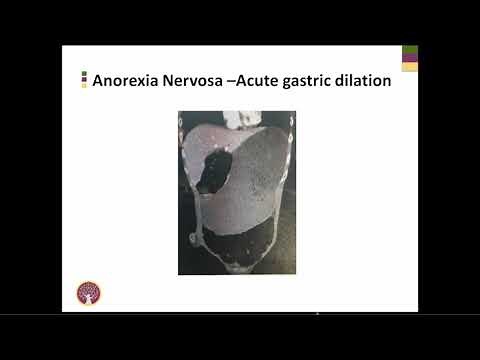 Medical Complications of Anorexia Nervosa, ARFID and Bulimia