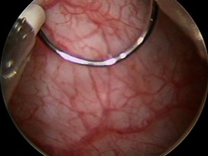 Probe-based Confocal Laser Endomicroscopy of the Urinary Tract: The Technique