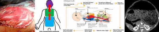 Abdominal compartment syndrome