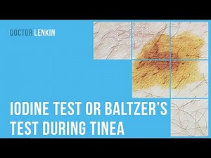 ➡ Iodine test or Baltzer’s test during tinea versicolor