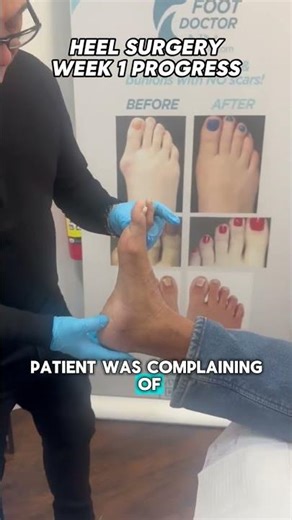 Heel spur surgery – week 1 update