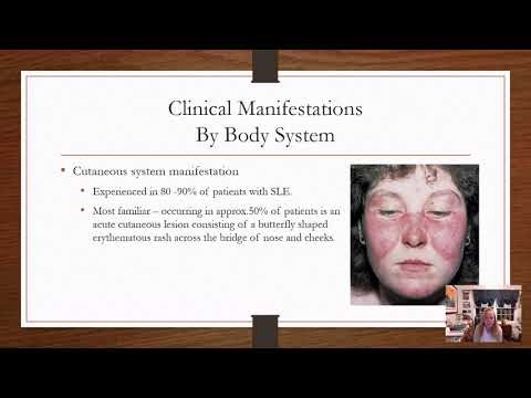 LupusSLE Voice Over PPT Complete Lecture