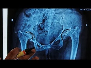 Double Hip Replacement# in MRKH Syndrome (Mayer Rokitansky Kuster Hauser ) # by MIS Technique