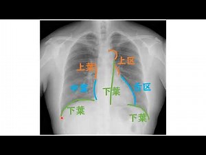 わかりやすイイ 胸部X線写真読影 アドバンス4 胸部X線単純写真正面像における上葉・中葉・下葉の位置
