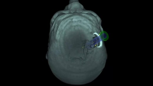 New brain tumor treatments are being brought to patients faster at Mayo Clinic through cutting-edge research. | Mayo Clinic