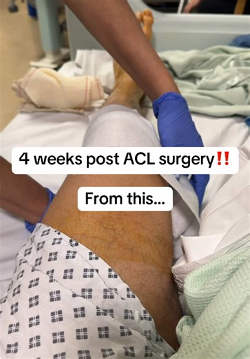 4 weeks post ACL surgery✅ Heading in the right direction📈 If you’ve had ACL surgery, keep pushing the progress will soon show🤝 I’ve still got a very long way to go but confidence in the knee is improving significantly and everything feels better day by day👌 Back to the physio tomorrow to review progress💪 Let me know how you’re getting on✅ ——————— * It's important to remember that everyone recovers at different speeds. Also, not every surgery is the same which will play a part in recovery. As