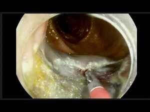 Colon EMR with a Novel Submucosal Injection Agent