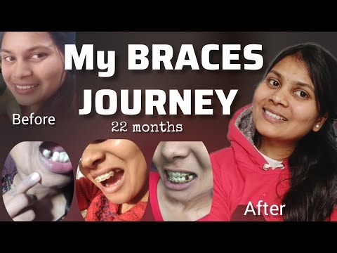 My New Smile! ✨22 Month Braces Journey 🦷 Goodbye Braces! 😵‍💫#bracesjourney 