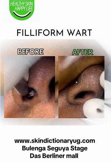 Understanding Filiform Warts in the Nose