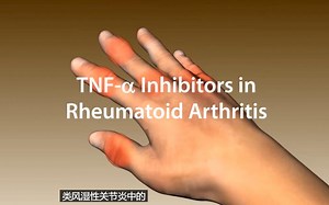 TNF-a 治疗类风湿关节炎机制