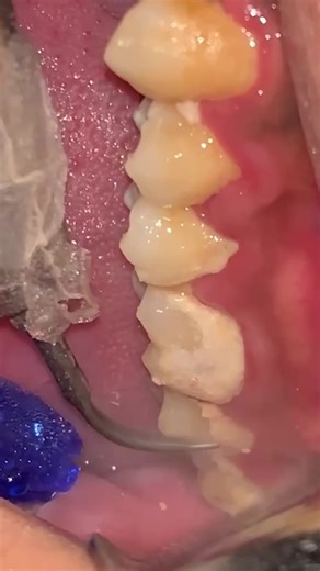 Effective Tartar Removal Tips from Your Dentist