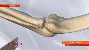 EVOLVE™ PROLINE Radial Head System Animation
